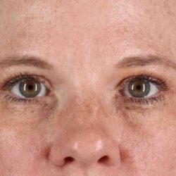 Blepharoplasty (Eyelid Surgery) Before & After Patient #4459