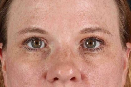 Blepharoplasty (Eyelid Surgery) Before & After Patient #4459