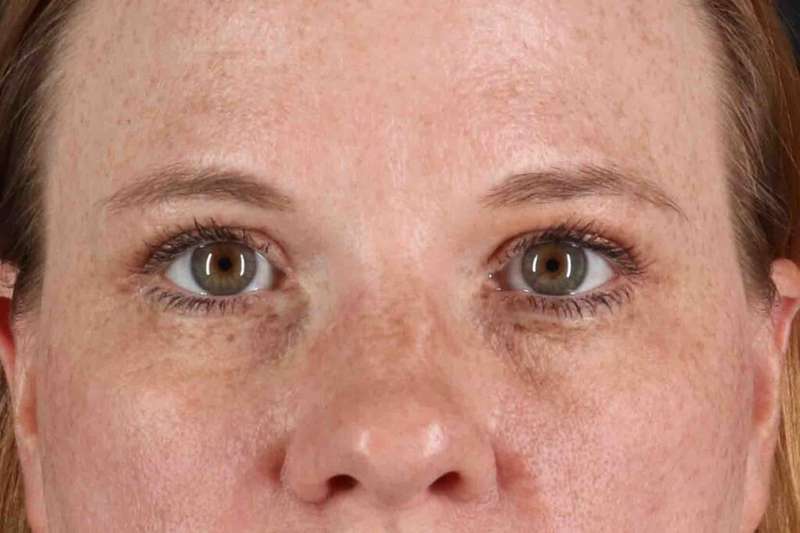 Blepharoplasty (Eyelid Surgery) Before & After Patient #4459
