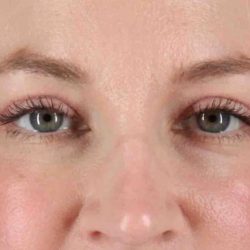 Blepharoplasty (Eyelid Surgery) Before & After Patient #4470