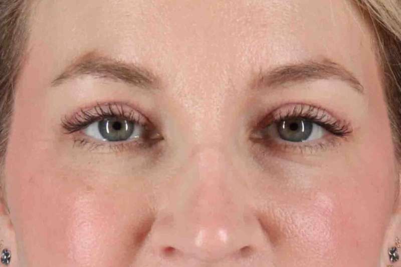 Blepharoplasty (Eyelid Surgery) Before & After Patient #4470