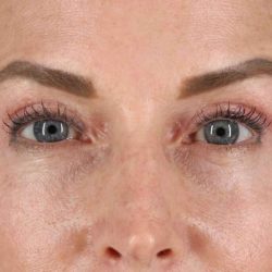 Blepharoplasty (Eyelid Surgery) Before & After Patient #4481
