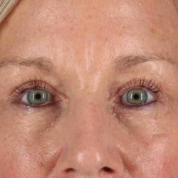 Blepharoplasty (Eyelid Surgery) Before & After Patient #4492