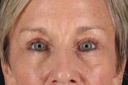 Blepharoplasty (Eyelid Surgery) Before & After Patient #4492