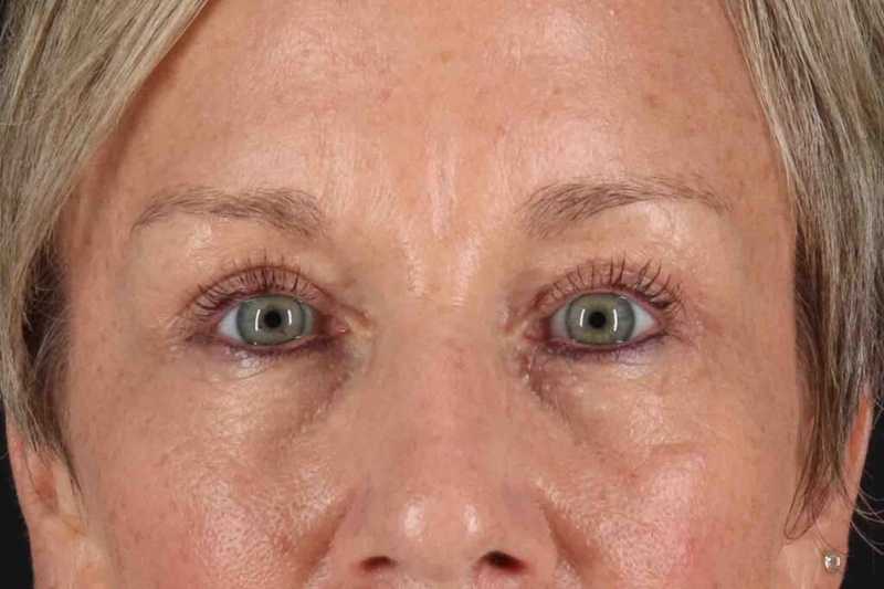 Blepharoplasty (Eyelid Surgery) Before & After Patient #4492