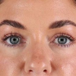 Blepharoplasty (Eyelid Surgery) Before & After Patient #4503