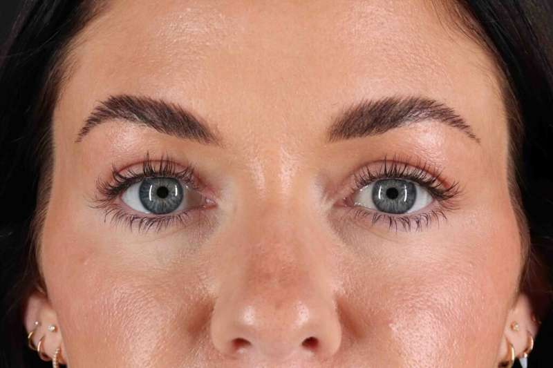 Blepharoplasty (Eyelid Surgery) Before & After Patient #4503