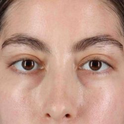Blepharoplasty (Eyelid Surgery) Before & After Patient #4514