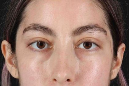 Blepharoplasty (Eyelid Surgery) Before & After Patient #4514