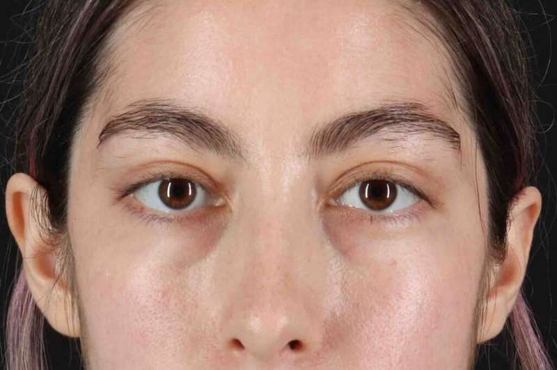 Blepharoplasty (Eyelid Surgery) Before & After Patient #4514