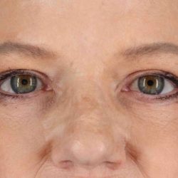 Blepharoplasty (Eyelid Surgery) Before & After Patient #4525