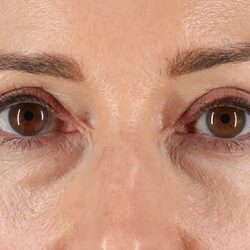 Blepharoplasty (Eyelid Surgery) Before & After Patient #4539