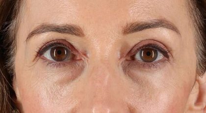 Blepharoplasty (Eyelid Surgery) Before & After Patient #4539