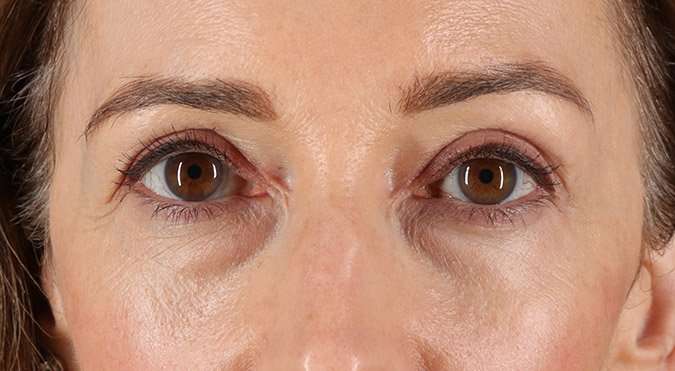Blepharoplasty (Eyelid Surgery) Before & After Patient #4539
