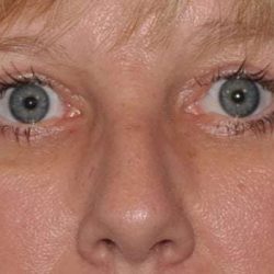 Blepharoplasty (Eyelid Surgery) Before & After Patient #4546