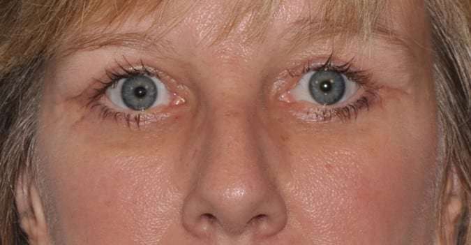 Blepharoplasty (Eyelid Surgery) Before & After Patient #4546