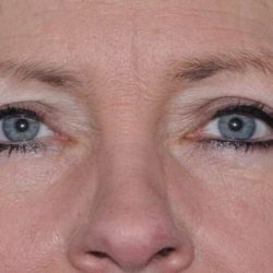 Blepharoplasty (Eyelid Surgery) Before & After Patient #4553