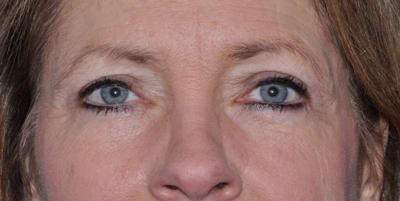 Blepharoplasty (Eyelid Surgery) Before & After Patient #4553
