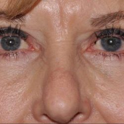Blepharoplasty (Eyelid Surgery) Before & After Patient #4560