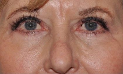 Blepharoplasty (Eyelid Surgery) Before & After Patient #4560