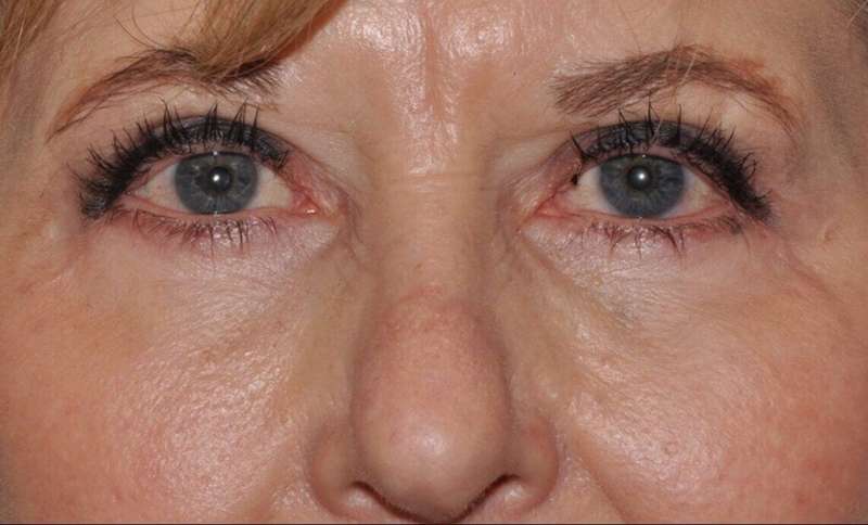 Blepharoplasty (Eyelid Surgery) Before & After Patient #4560