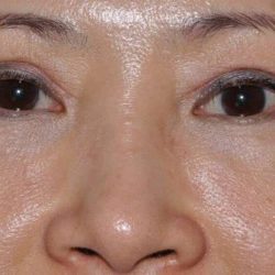 Blepharoplasty (Eyelid Surgery) Before & After Patient #4567