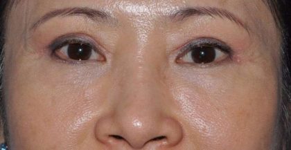 Blepharoplasty (Eyelid Surgery) Before & After Patient #4567