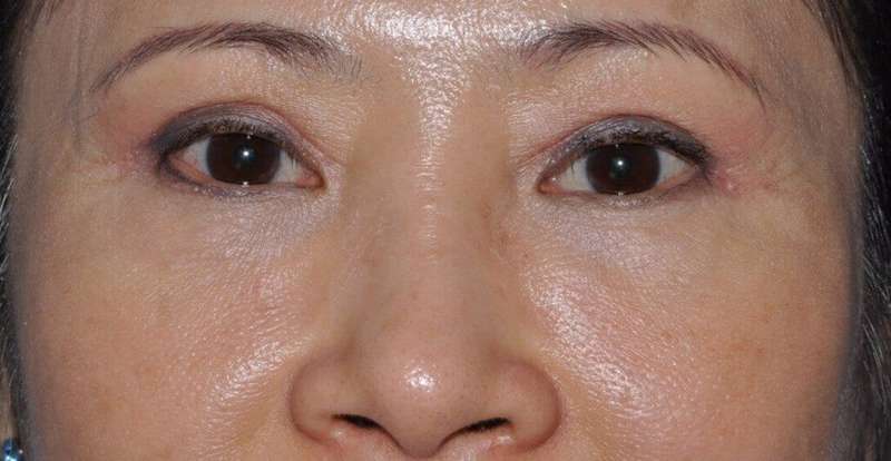 Blepharoplasty (Eyelid Surgery) Before & After Patient #4567