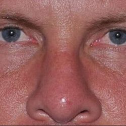 Blepharoplasty (Eyelid Surgery) Before & After Patient #4574