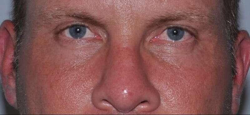 Blepharoplasty (Eyelid Surgery) Before & After Patient #4574