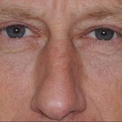 Blepharoplasty (Eyelid Surgery) Before & After Patient #4581