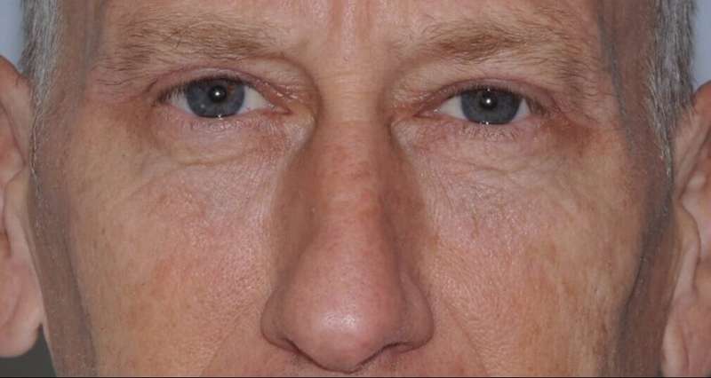Blepharoplasty (Eyelid Surgery) Before & After Patient #4581