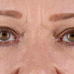 Blepharoplasty (Eyelid Surgery) Before & After Patient #4588
