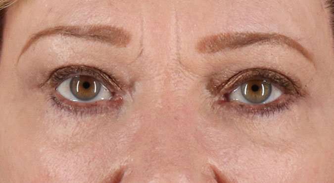 Blepharoplasty (Eyelid Surgery) Before & After Patient #4588