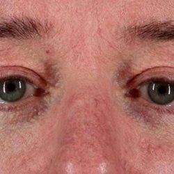 Blepharoplasty (Eyelid Surgery) Before & After Patient #4599