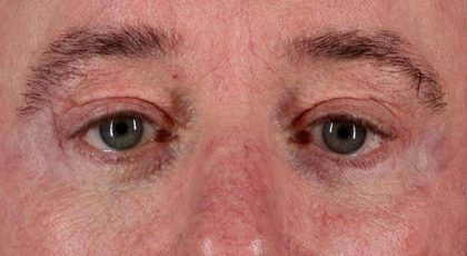 Blepharoplasty (Eyelid Surgery) Before & After Patient #4599
