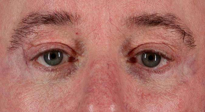 Blepharoplasty (Eyelid Surgery) Before & After Patient #4599