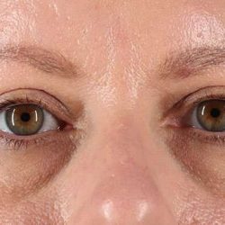 Blepharoplasty (Eyelid Surgery) Before & After Patient #4602