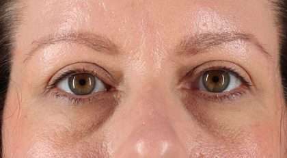 Blepharoplasty (Eyelid Surgery) Before & After Patient #4602