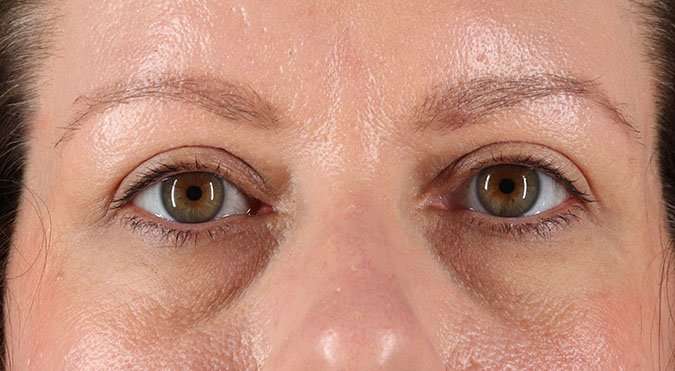 Blepharoplasty (Eyelid Surgery) Before & After Patient #4602