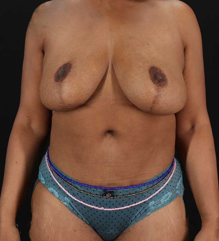 Abdominoplasty (Tummy Tuck) Before & After Patient #990