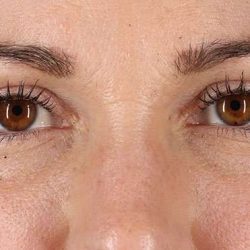 Blepharoplasty (Eyelid Surgery) Before & After Patient #4605