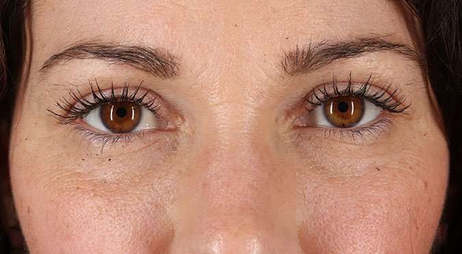 Blepharoplasty (Eyelid Surgery) Before & After Patient #4605