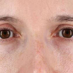 Blepharoplasty (Eyelid Surgery) Before & After Patient #4608