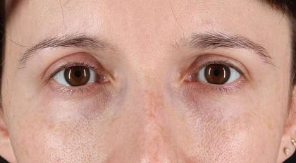 Blepharoplasty (Eyelid Surgery) Before & After Patient #4608