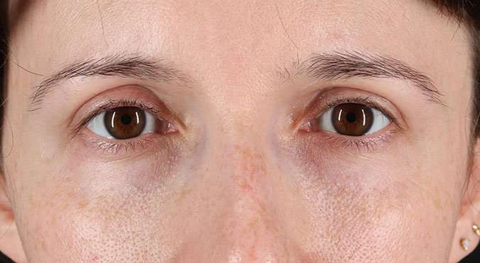 Blepharoplasty (Eyelid Surgery) Before & After Patient #4608