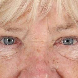 Blepharoplasty (Eyelid Surgery) Before & After Patient #4611