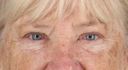 Blepharoplasty (Eyelid Surgery) Before & After Patient #4611