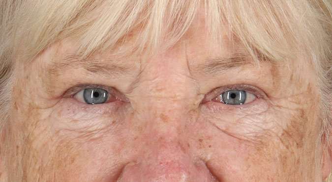 Blepharoplasty (Eyelid Surgery) Before & After Patient #4611