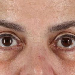 Blepharoplasty (Eyelid Surgery) Before & After Patient #4614